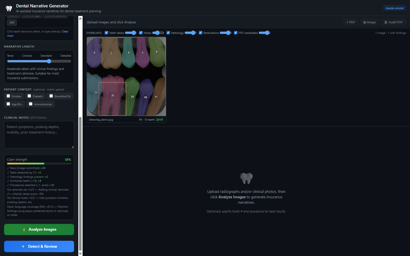 The narrative generator UI: a periapical radiograph with per-tooth SAM masks in distinct colors, Universal tooth numbers, overlay toggles for teeth labels, masks, pathology, restorations, and FPD candidates, alongside a narrative-length slider, patient-context toggles, and a live claim-strength meter reading 58 percent with a per-category point breakdown.